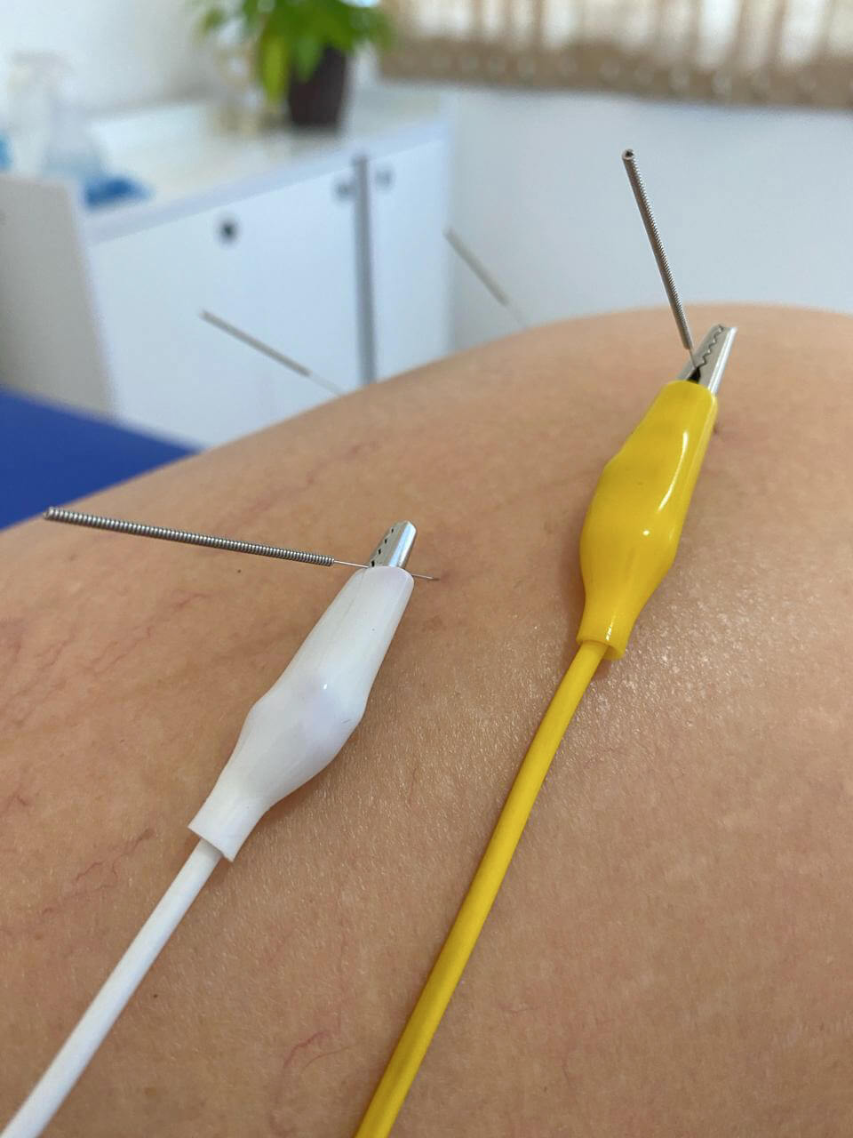 Aplicação de laserterapia em paciente